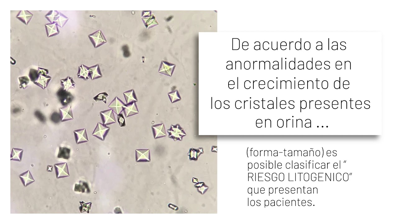 La Formaci n De Cristales En La Orina qu Significa Todo Sobre 